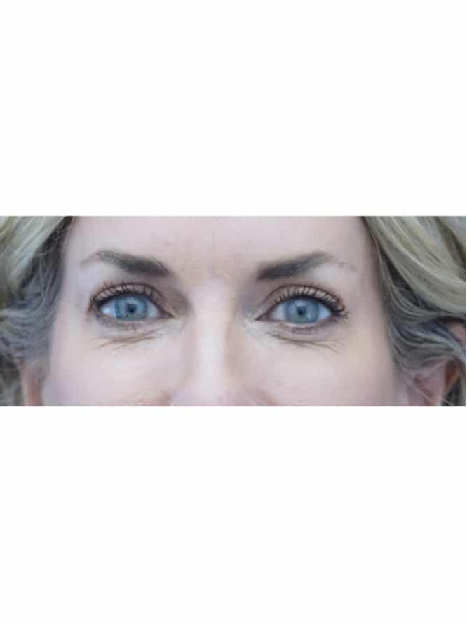 Brightening Eyes — After