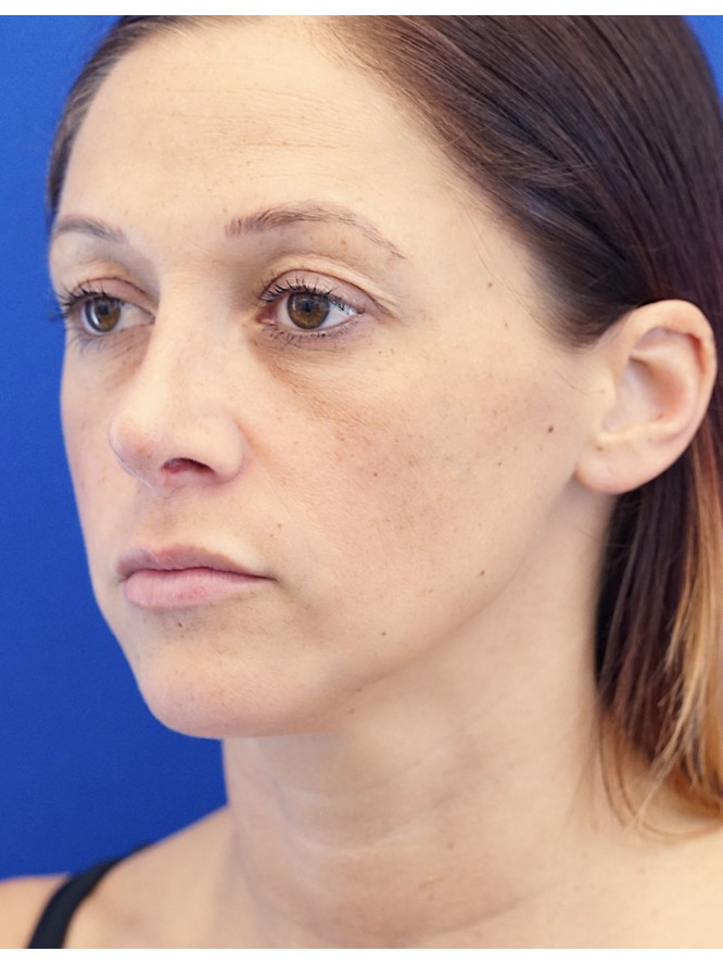 Dainty Nose — After