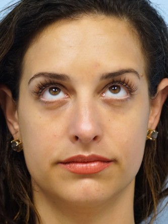 Lower Eyelid Dark Shadow* — After