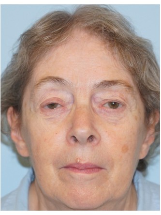 Visual Field Deficit – Eyelid Ptosis3* — Before