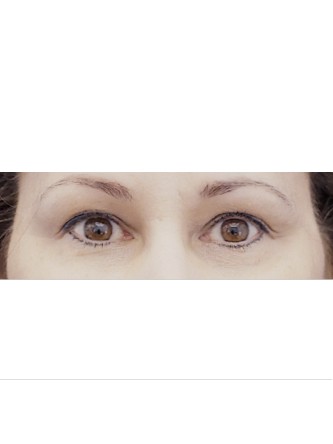 Sensual Upper Eyelids* — Before
