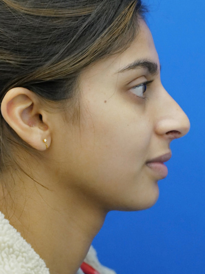 Natural Result — After
