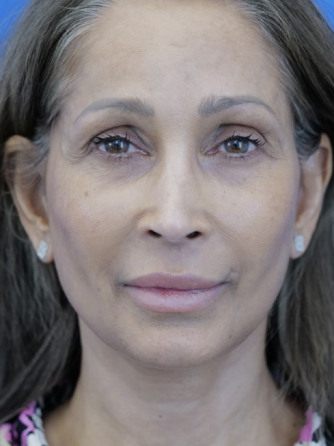 Face and Endobrow Lift — After