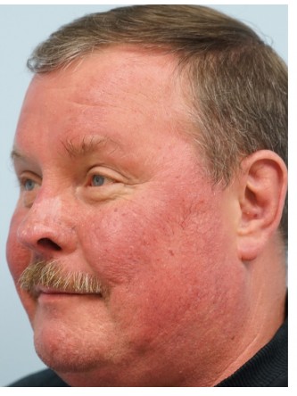 Rhinophyma* — After