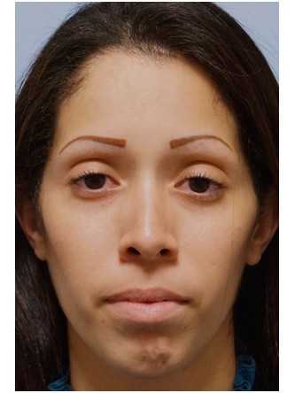 Nasal Obstruction – Crooked Nose2* — After