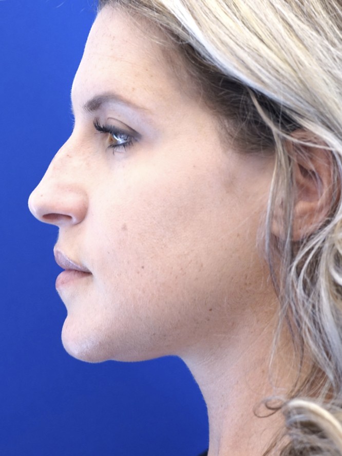 Aesthetic Nasal Profile — Before
