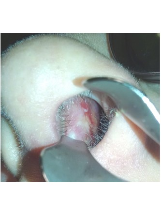 Nasal Septal Perforation3* — After
