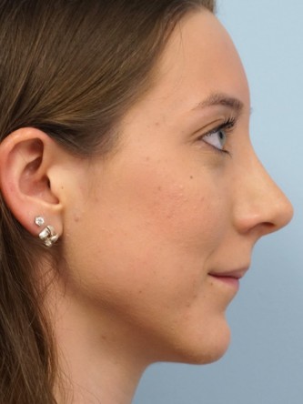 Nasal Hump Endonasal Rhinoplasty* — After