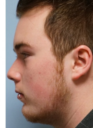 Crooked Nose Endonasal Technique3* — Before