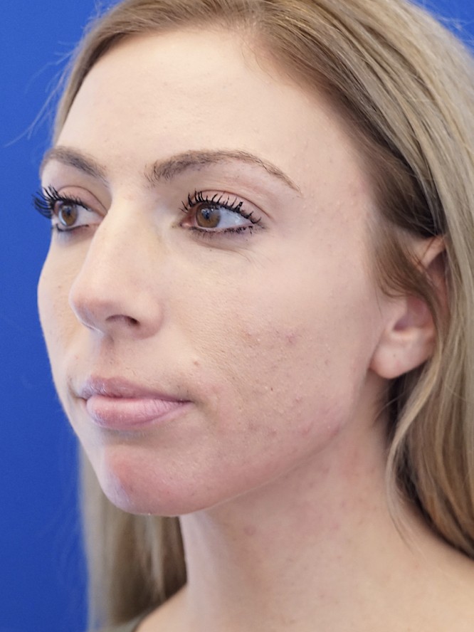 Endonasal Dainty Nose — Before
