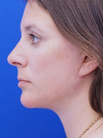 Facelift, Eyelid Lift, and Chin Liposuction* — After