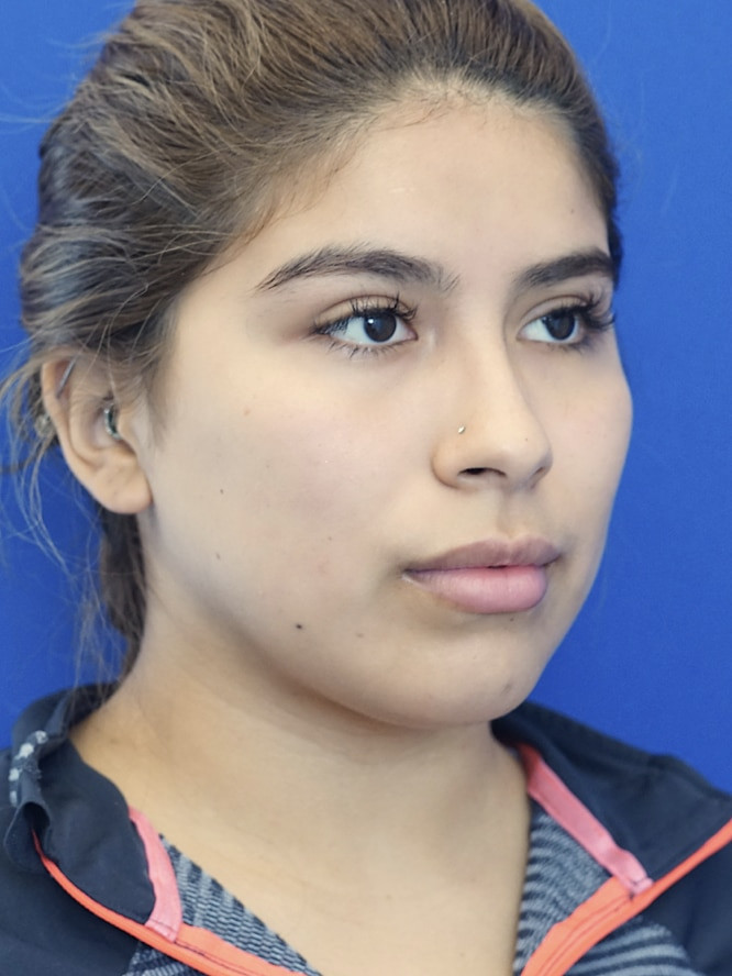 Cheek Contouring — Before