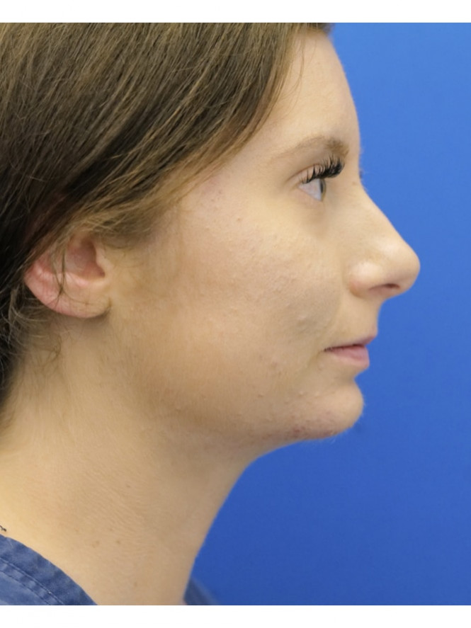 Chin Augmentation and Liposuction — After