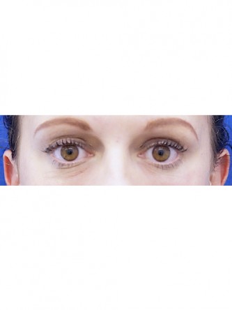 Lower Eyelid Hollow* — After