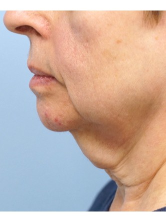 Neck Lift* — Before