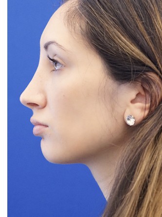 Nasal Profile Aesthetics — After