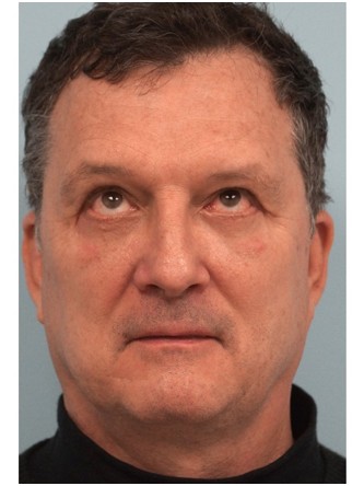 Lower Eyelid Excess Fat Pad2* — After