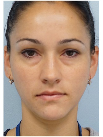 Restylane Silk to Tear Trough – Under Eye* — Before