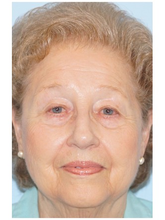Visual Field Deficit – Eyelid Ptosis1* — Before