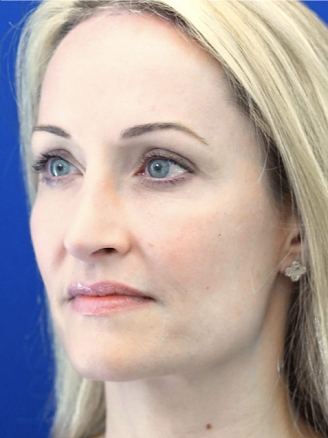 Trichophytic Browlift — After