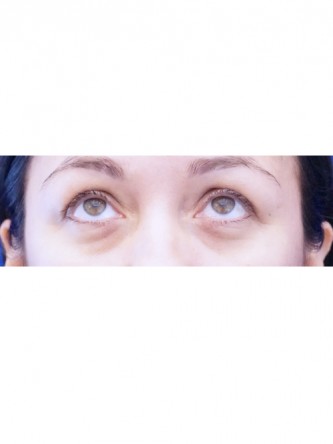 Tear Trough Fillers* — Before
