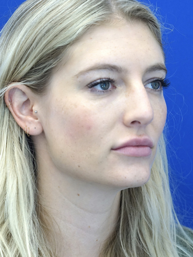 Aesthetic Nasal Contour — Before