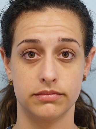 Lower Eyelid Dark Shadow* — Before