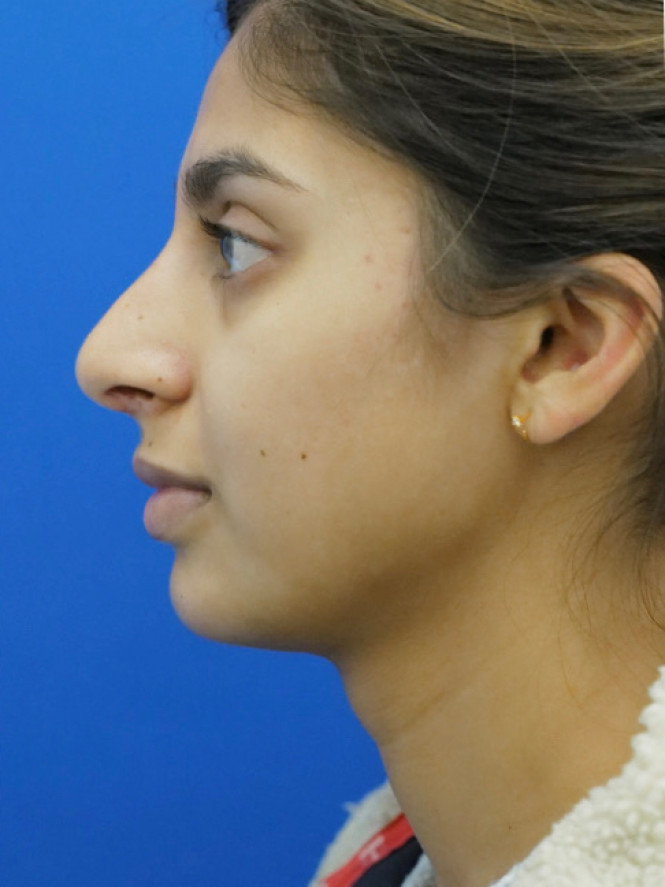 Natural Result — After