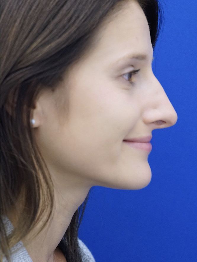 Case 3291: before Nasal Profile Bliss