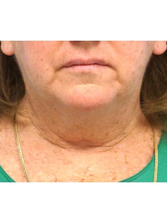 Short Oblique Neck* — Before