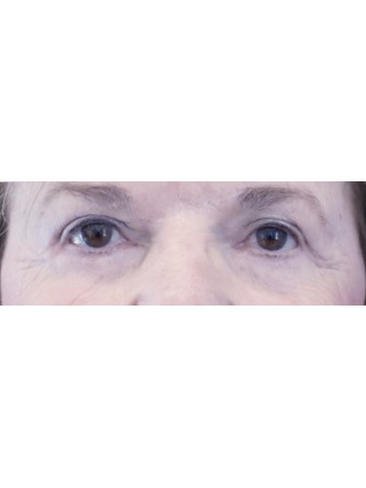 Lower Blepharoplasty with Canthopexy — After