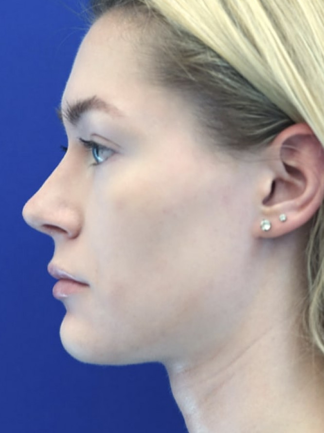 Nasal Profile Plasty — After
