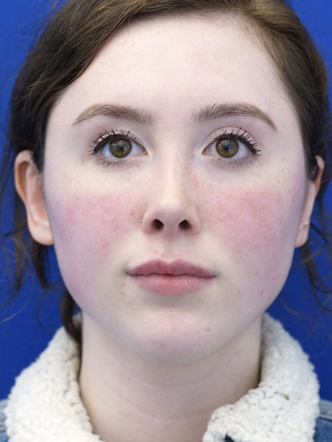 Right Revision Otoplasty — Before