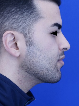 Case 2323: after Vertical Lengthening Chin*
