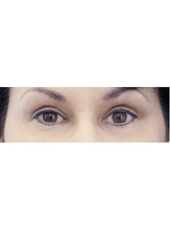 Sensual Upper Eyelids* — After