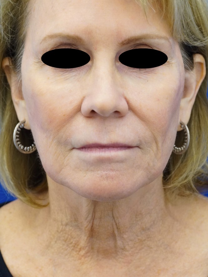 Secondary Deep Plane Facelift — Before