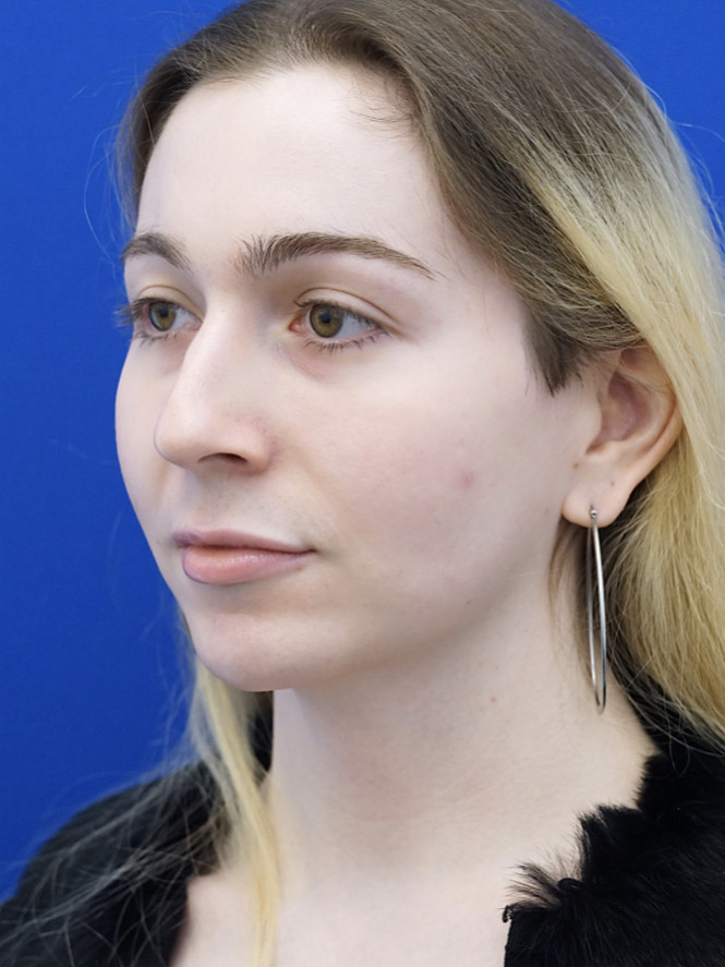 Soften Nasal Contour — Before