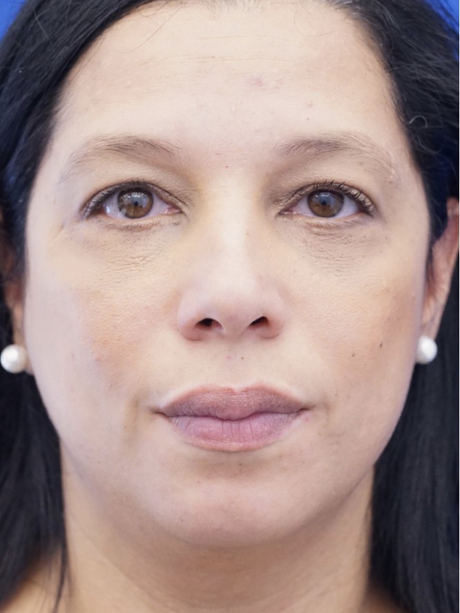 Lower Lid Fat Reposition — After