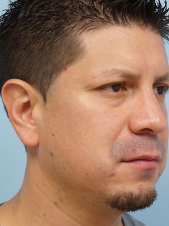 Protruding Ears – Upper Third* — Before