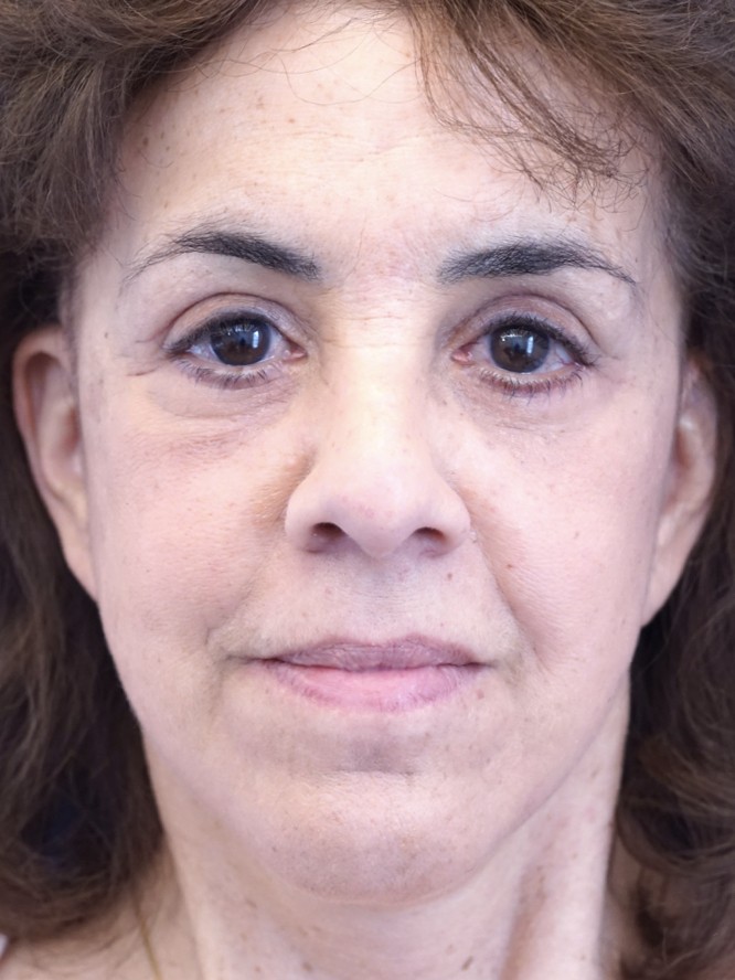 Festoon and Left Ptosis Repair — After