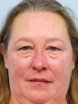 Upper and Lower Eyelid Blepharoplasty* — Before