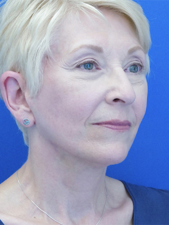Deep Plane Naturale — After