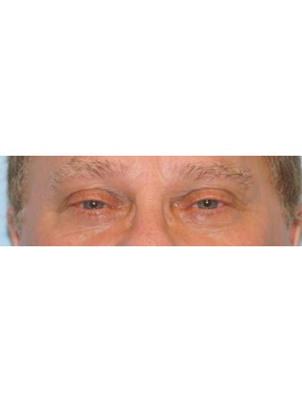Sleepy Eyes* — Before