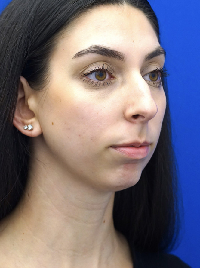 Facial Profile Balance — Before