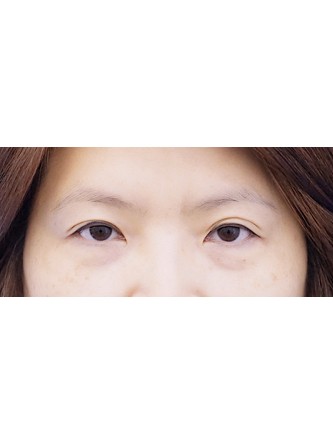 Lower Eyelid Loose Skin and Hollow* — Before