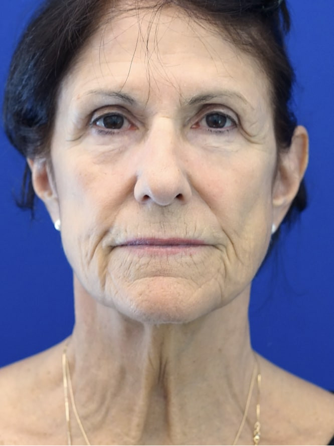 Revision Forehead and Facelift — Before