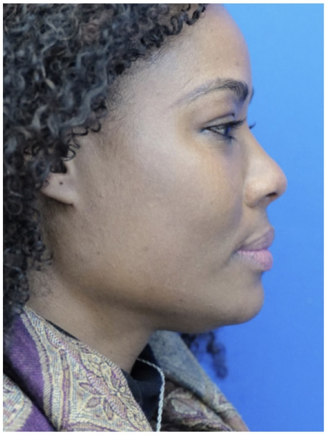 Cheek and Chin — Before