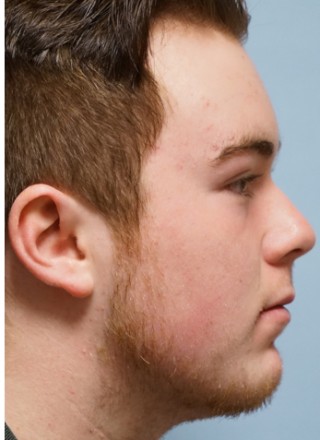 Crooked Nose Endonasal Technique3* — Before