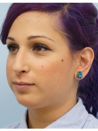 Juvederm Upper and Lower Lip Fillers* — Before