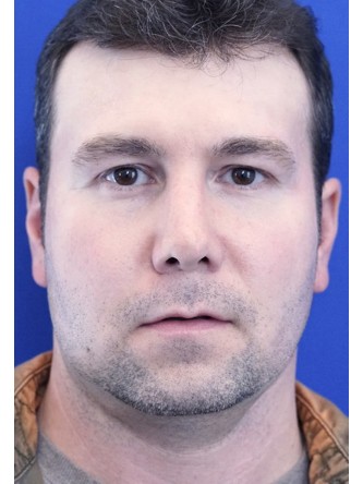 Define Upper Eyelid Crease — Before